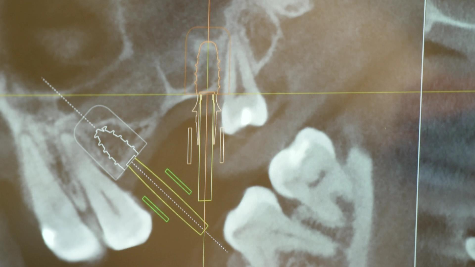 Große Unterschiede bei veranschlagten Kosten für Implantate