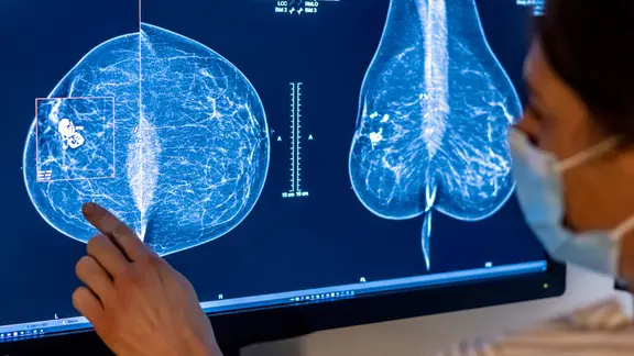 Medizinisches Personal untersucht mit einer Mammografie die Brust einer Frau auf Brustkrebs.